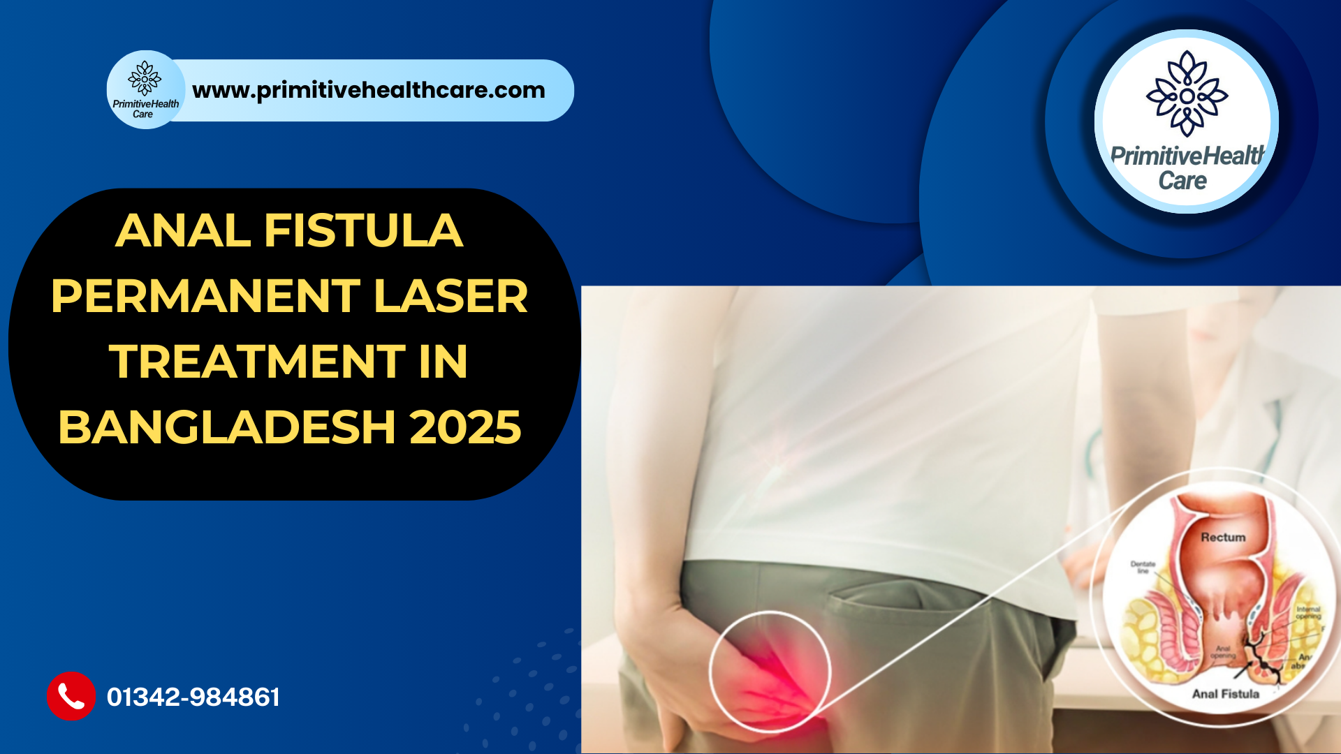 Anal Fistula Permanent Laser Treatment in Bangladesh 2025